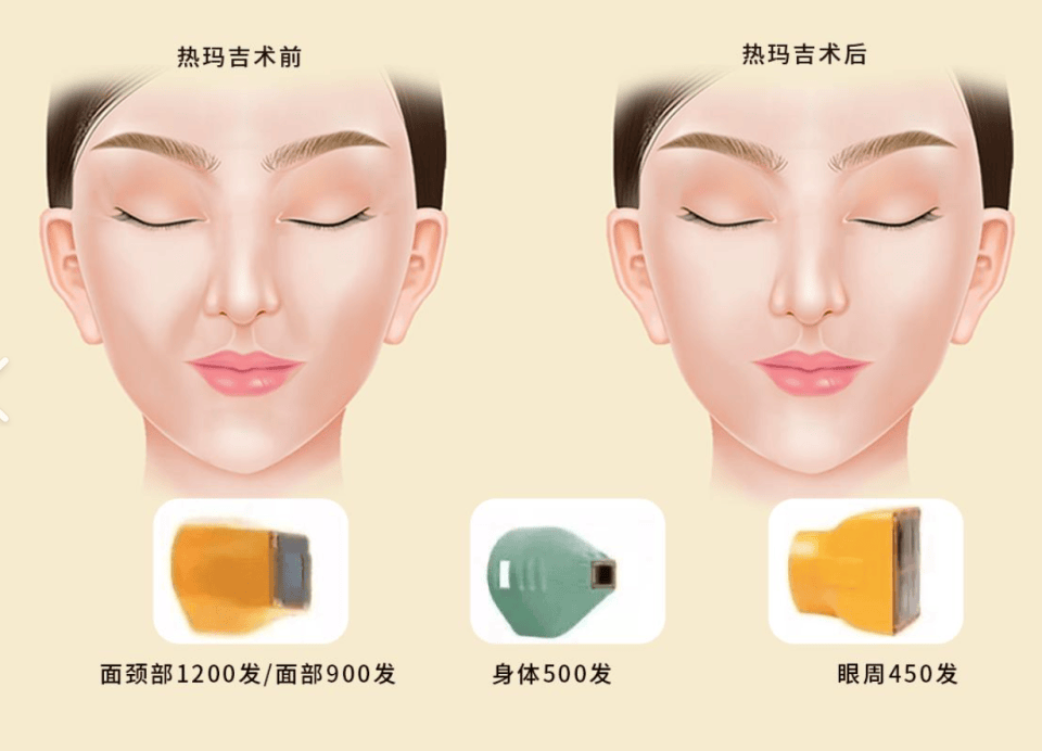 差别:超玛吉和热玛吉的区别,超声炮和热玛吉效果的区别